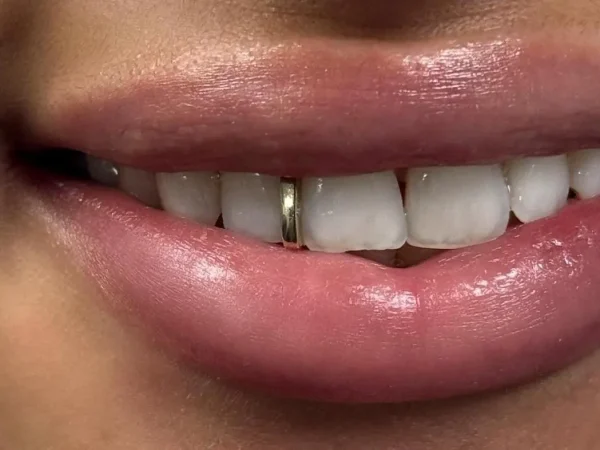 Single Stone Gap Filler Grillz - Image 2
